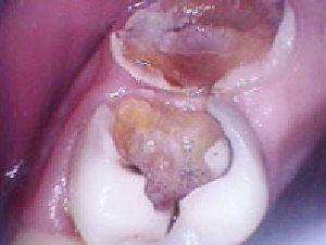 上顎臼歯部のむし歯
