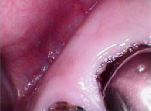 上顎大臼歯