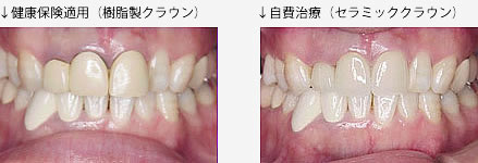 自費治療と保険治療の比較