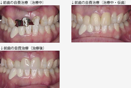 自費治療と保険治療の比較