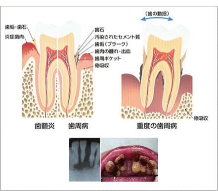 歯周病 図解