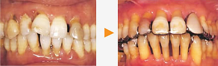 歯周病の症例写真
