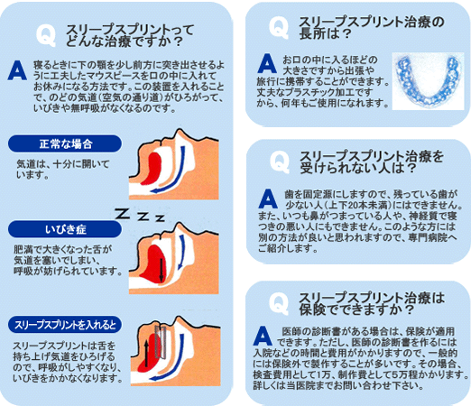 睡眠時無呼吸症候群 スリープスプリント faq