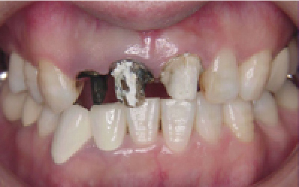 前歯の自費治療（治療中）