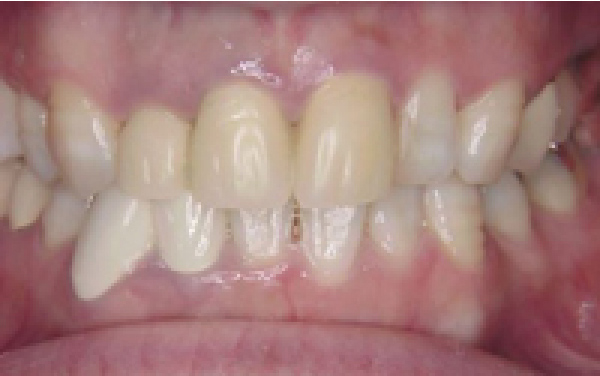 前歯の自費治療（治療中・仮歯）