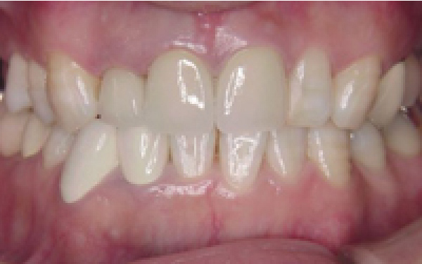 前歯の自費治療（治療後）