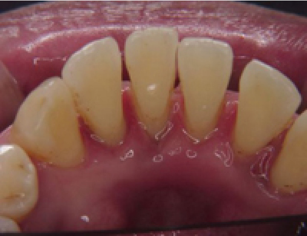 前歯の裏側（治療後）