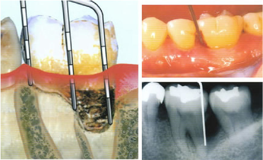 歯周病の検査方法