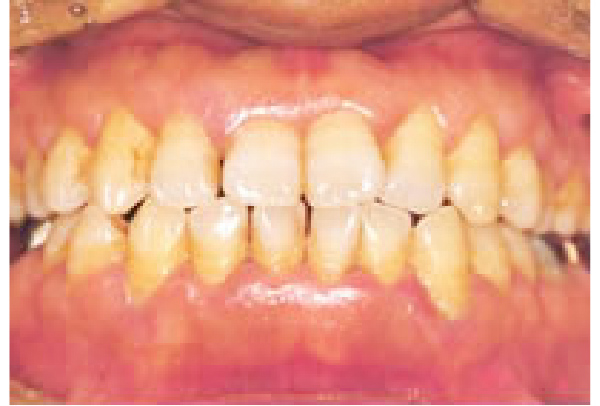 歯肉の腫脹と出血歯石の沈着、口臭