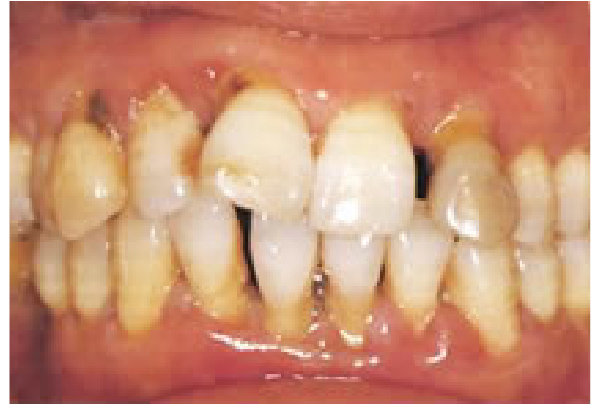 出血と排膿、歯牙の動揺、歯肉の腫脹と退縮