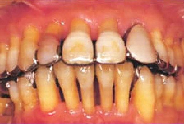 完治。極度の歯肉退縮
